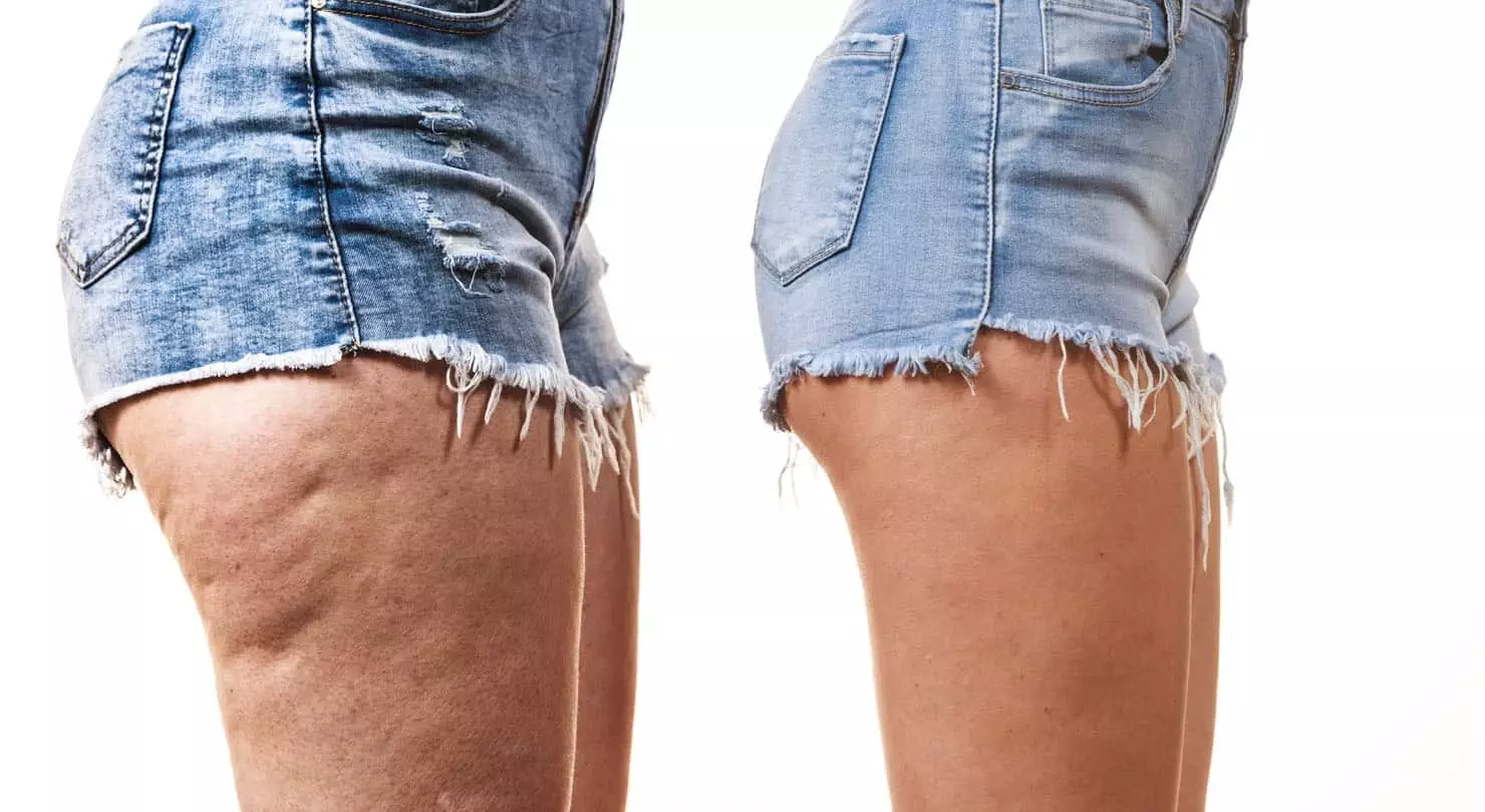 Una dieta saludable y ejercicios ayudan a eliminar la celulitis.